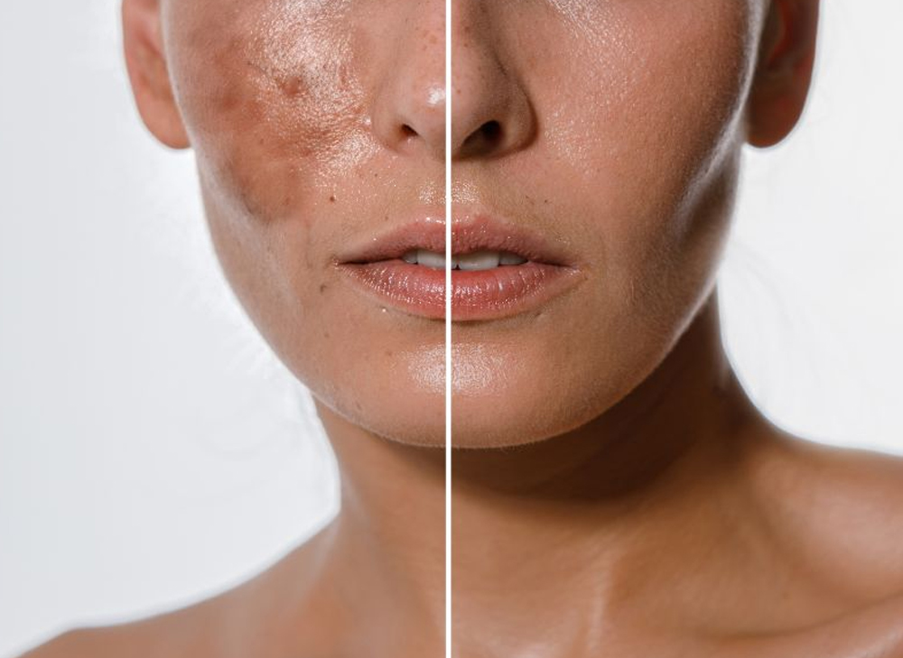 Chemical Peeling