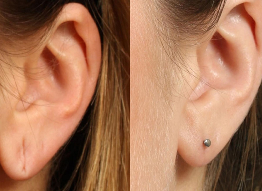 Earlobe Repair
