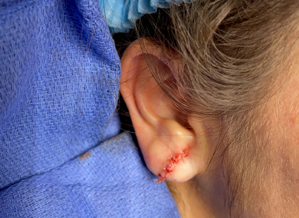 Earlobe Repair Benefits