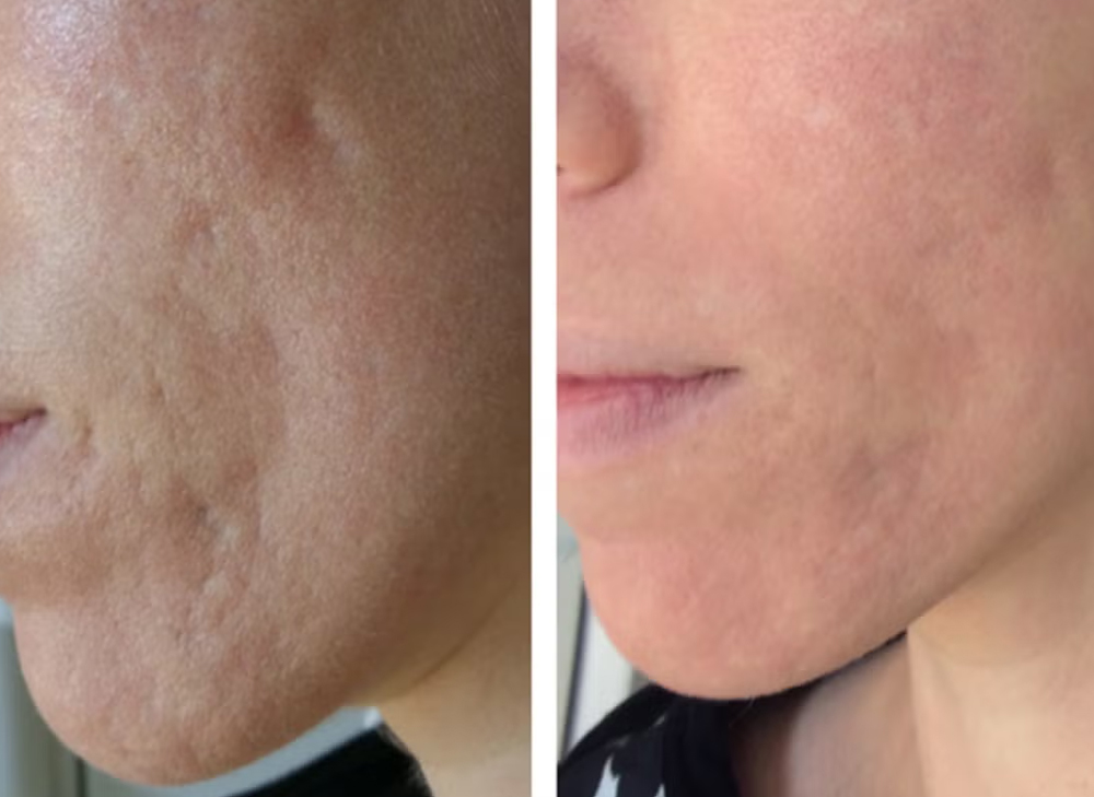 Laser Acne Scar Treatment