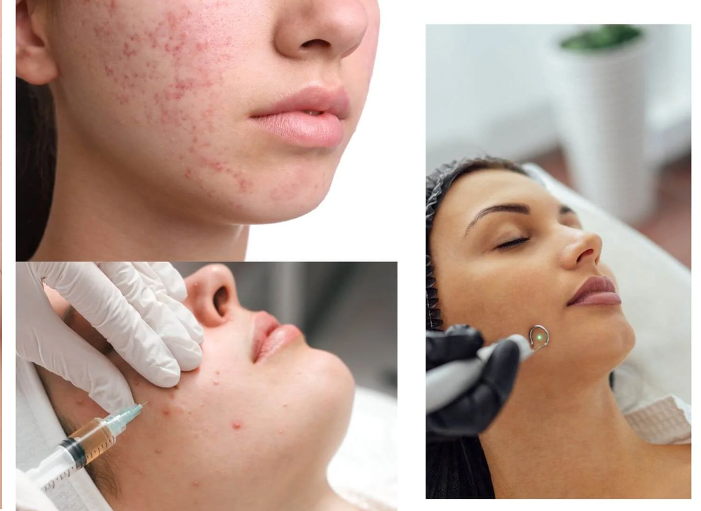Laser Acne Scar Treatment FAQs