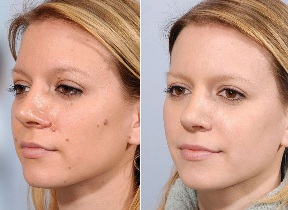 Mole Removal