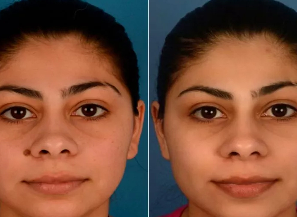 Mole Removal Benefits