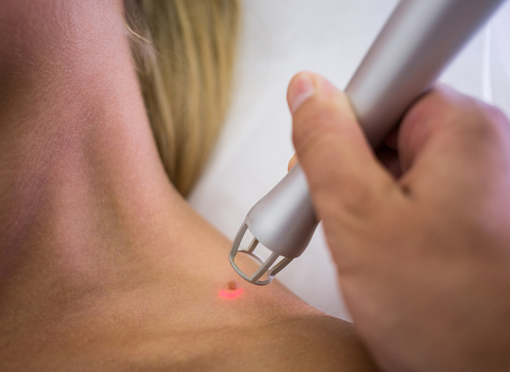 Mole Removal FAQs