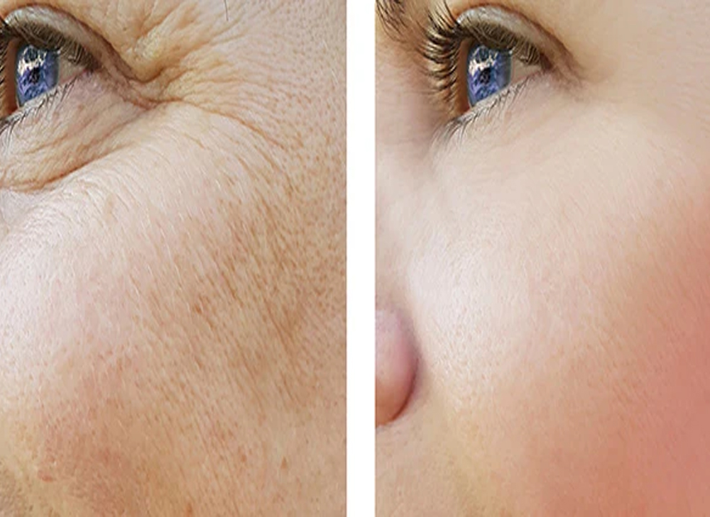 Skin Rejuvenation Treatment