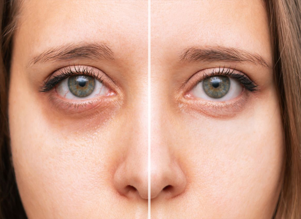 Under Eye Dark Circle Treatment
