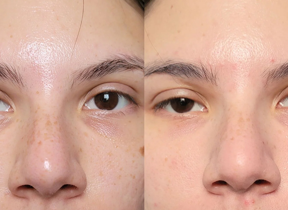 Dark Circle Treatment FAQs
