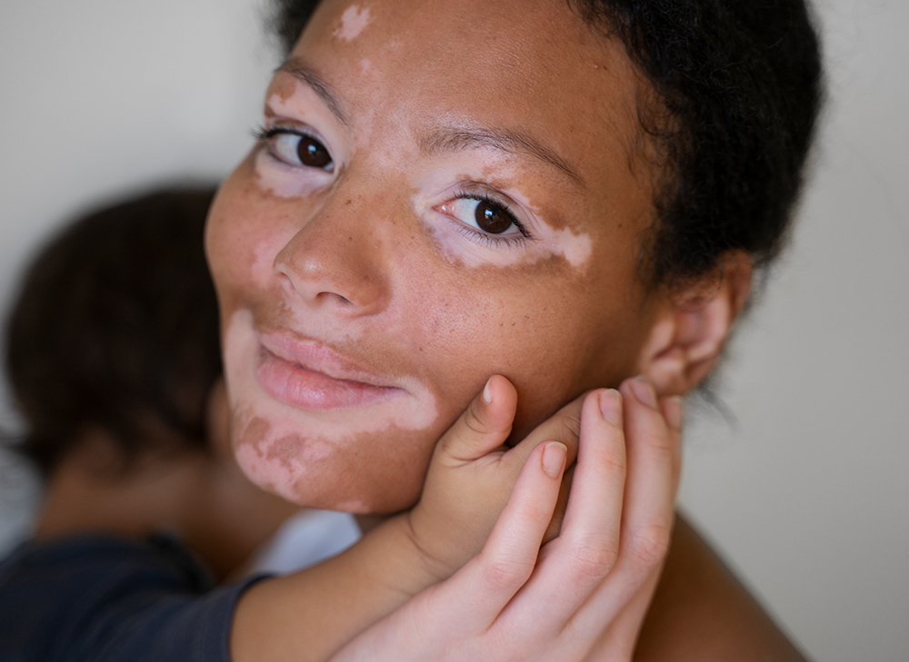 Vitiligo Treatment