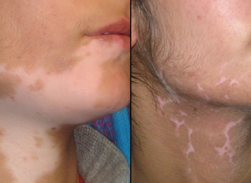 Vitiligo Treatment Options