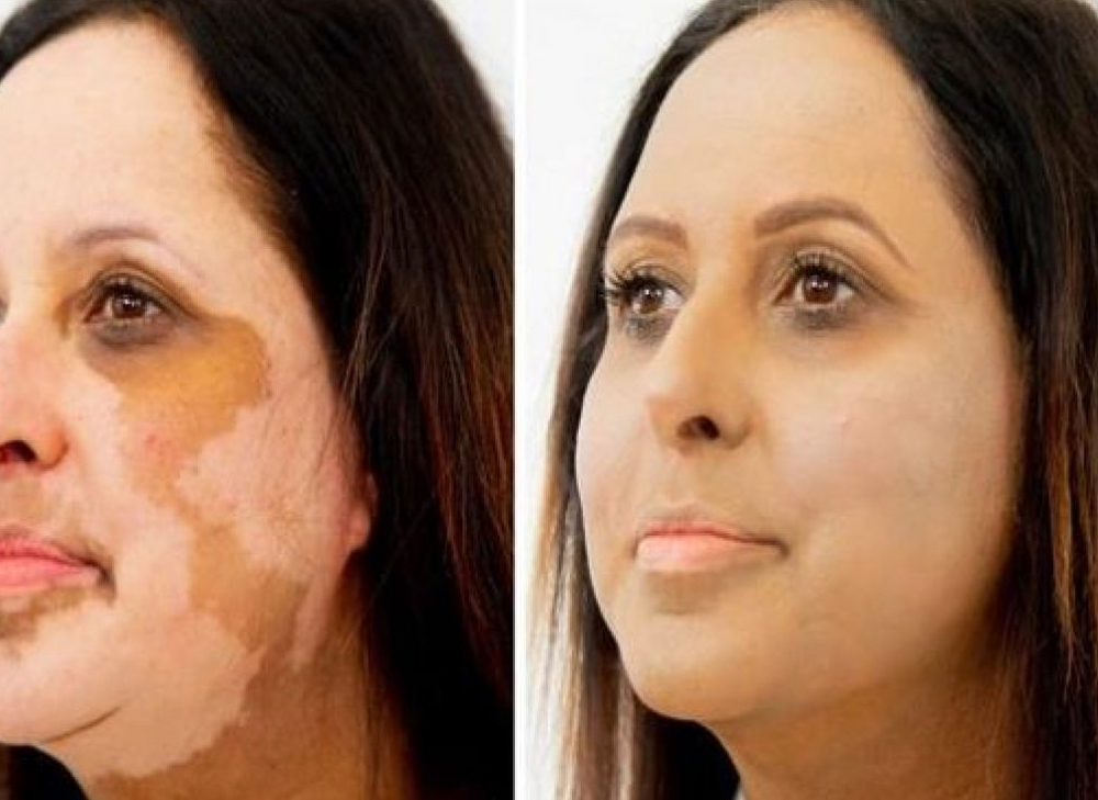 Vitiligo Treatment FAQs